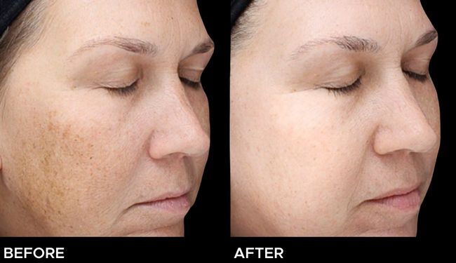 Before and after result of a woman after a VI chemical peel