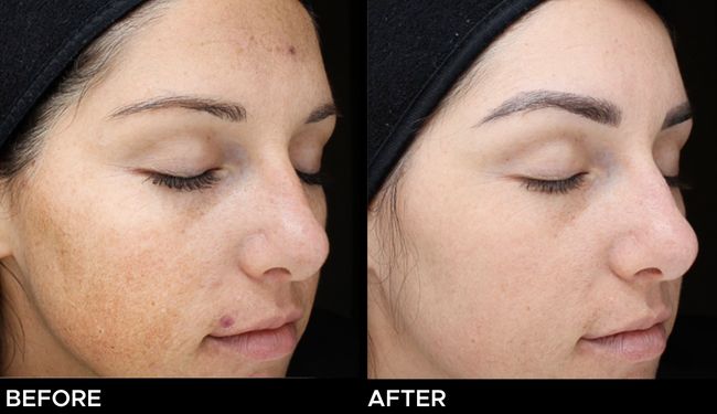 Before and after result of a young woman treated with a chemical peel.