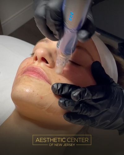 Woman getting SkinPen microneedling treatment of face for skin texture.