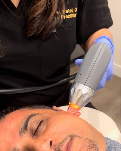 Man receiving a microneedling RF treatment on his face.