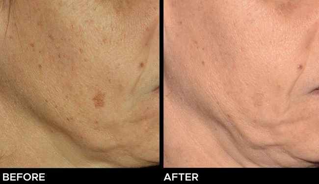 Before and after results of Ultra laser resurfacing treatments on a woman's face.