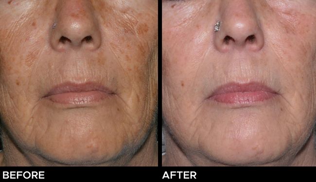 Before and after results of Ultra laser resurfacing treatments for sun damage on a woman's face.