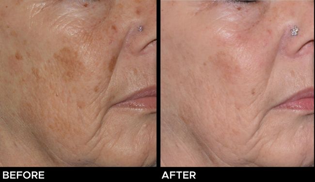 Before and after results of Ultra laser resurfacing treatments for sun damage on the side of a woman's face.