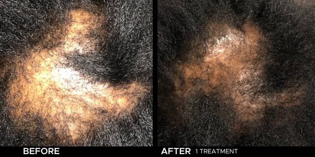 Before and after result of Keralase for thinning hair on a woman.