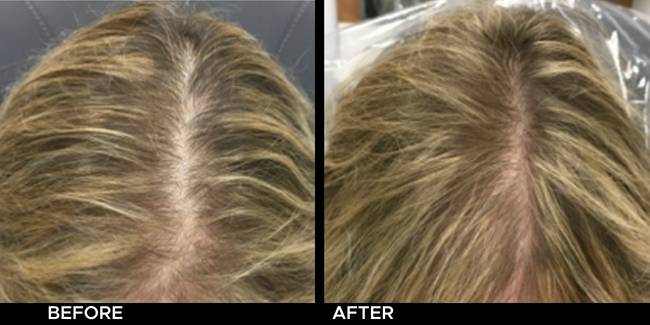 Before and after result of Keralase for thinning hair on a woman's part.