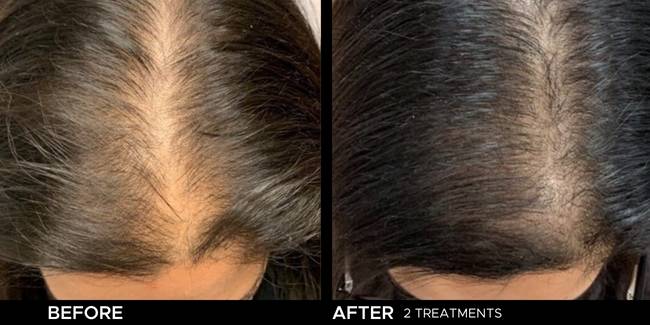 Before and after result of Keralase for hair loss on a woman's part.