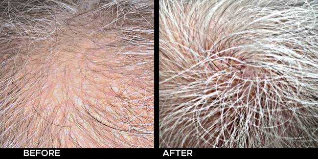 Before and after result of Keralase for thinning hair on a man.