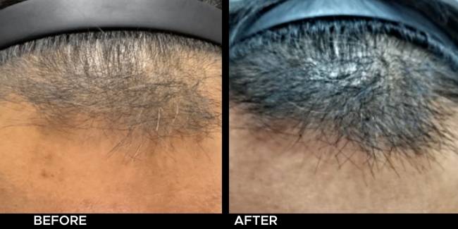 Before and after result of Keralase hair restoration for thinning hair on a man's hairline.