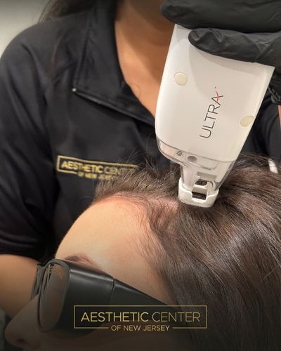 Woman receiving Keralase hair restoration treatment for thinning hair on her hairline.