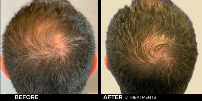 Before and after result of Keralase hair restoration for thinning hair on a man's crown.