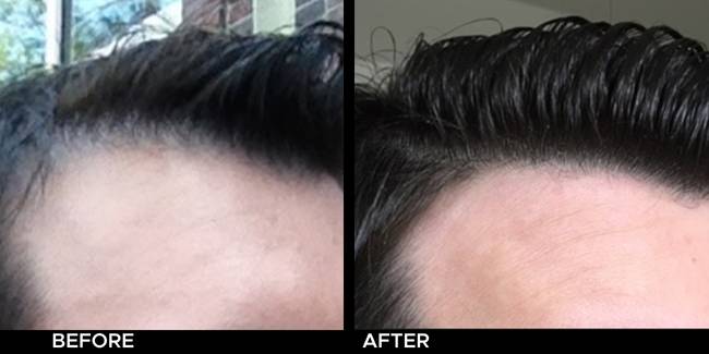 Before and after 6 KeraLase hair restoration treatments on thinning hair.