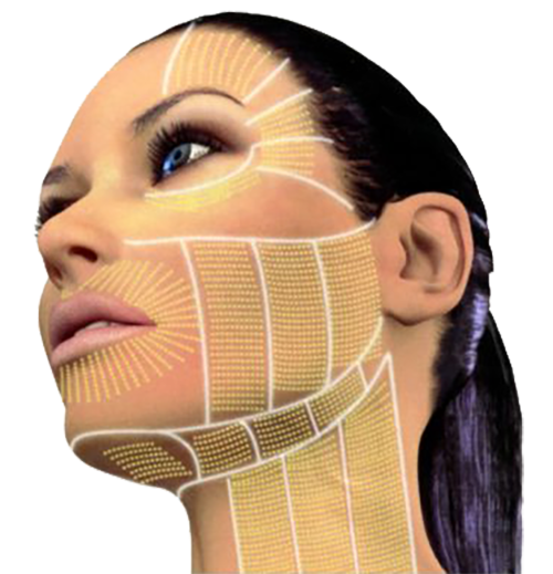 Ultherapy areas of treatment map on face and neck.