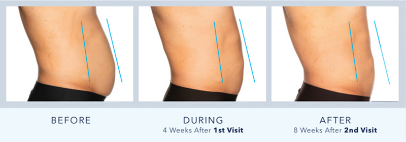 CoolSculpting After Pregnancy  Does CoolSculpting Work on Stomach Fat  After Pregnancy? - Element Body Lab