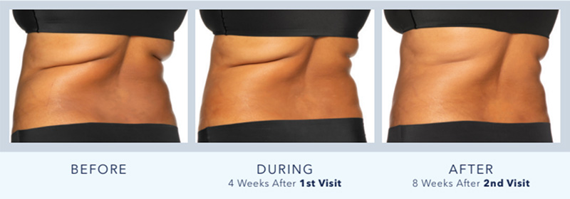 Coolsculpting, Freeze Fat In Randolph, NJ