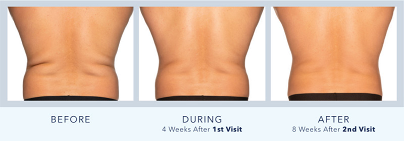 Before and after results progress of CoolSculpting on love handles and back fat. 