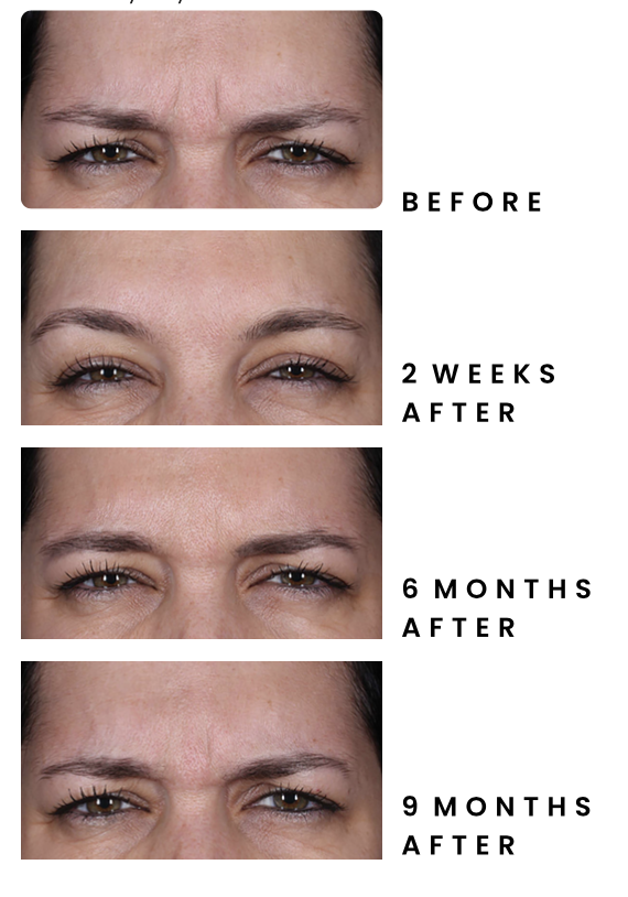 Before and after comparison of Daxxify results.